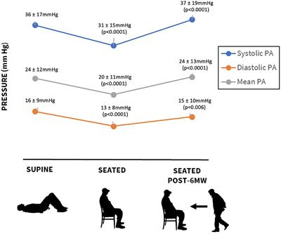 Impact of exercise on pulmonary artery pressure in patients with heart failure using an ambulatory pulmonary artery pressure monitor